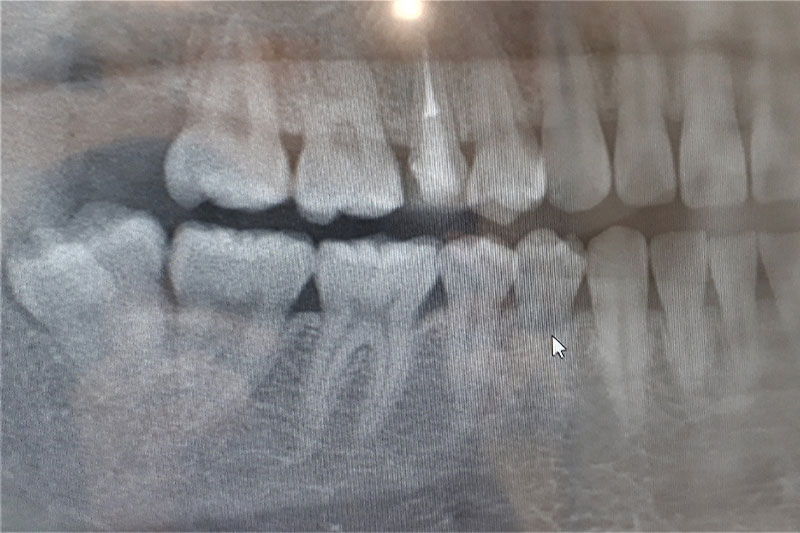 親知らずの抜歯